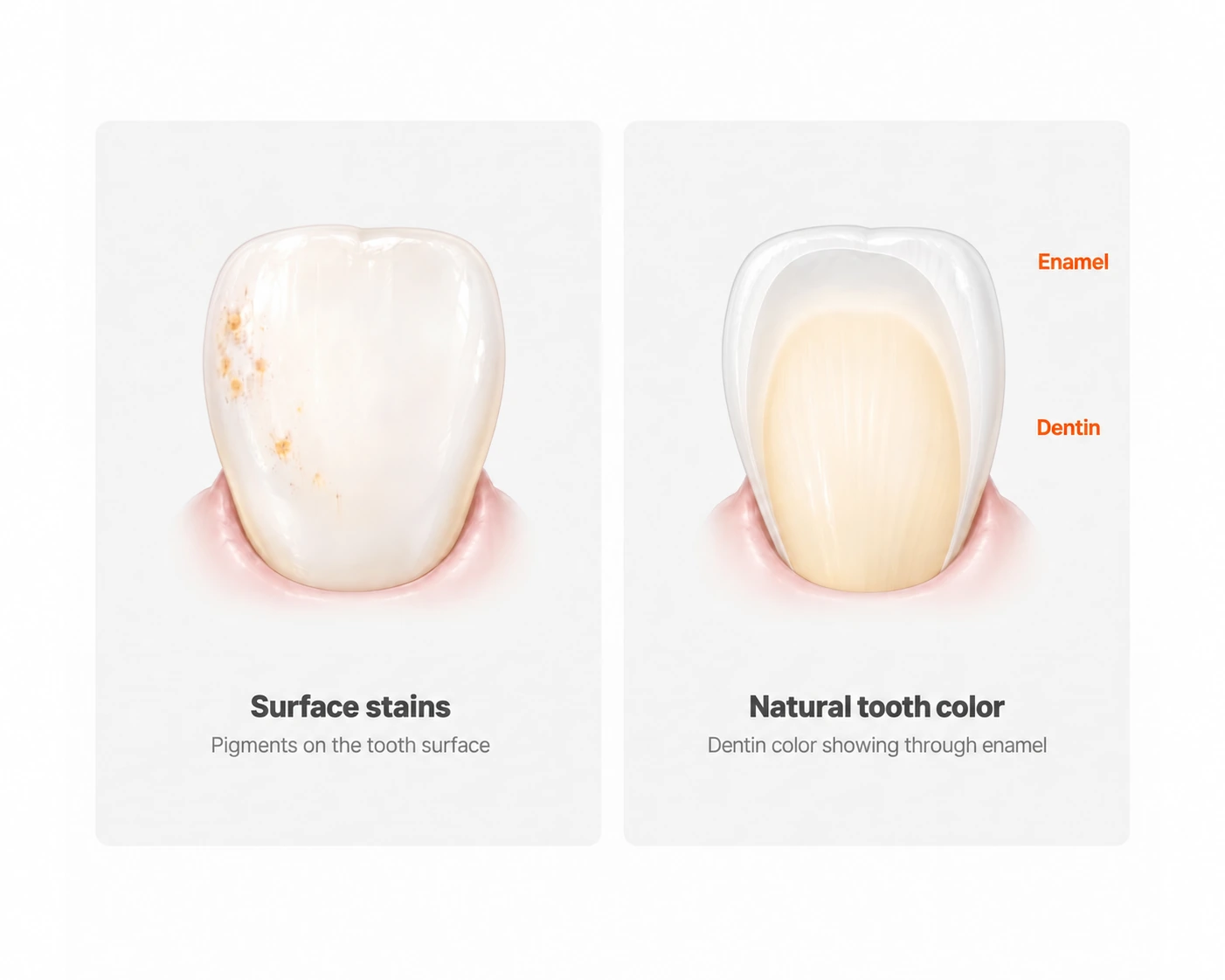 Left: pigments on the tooth surface. Right: the natural color of dentin showing through enamel.
