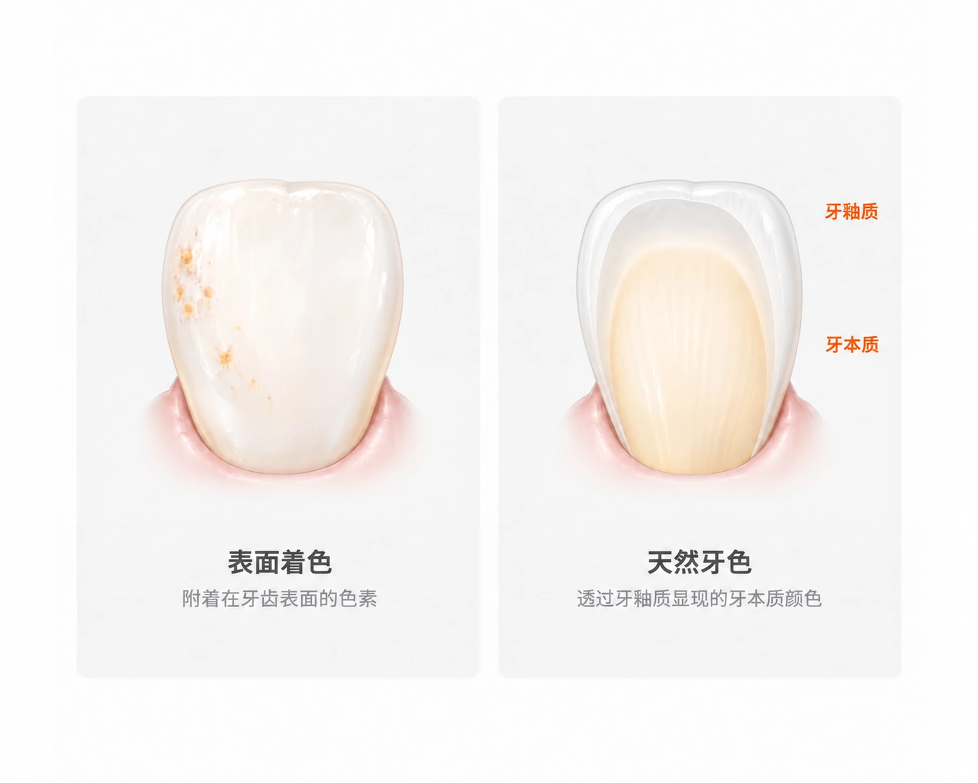 左:附着在牙齿表面的色素。右:牙本质的颜色透过牙釉质显现,形成天然牙本来的颜色。