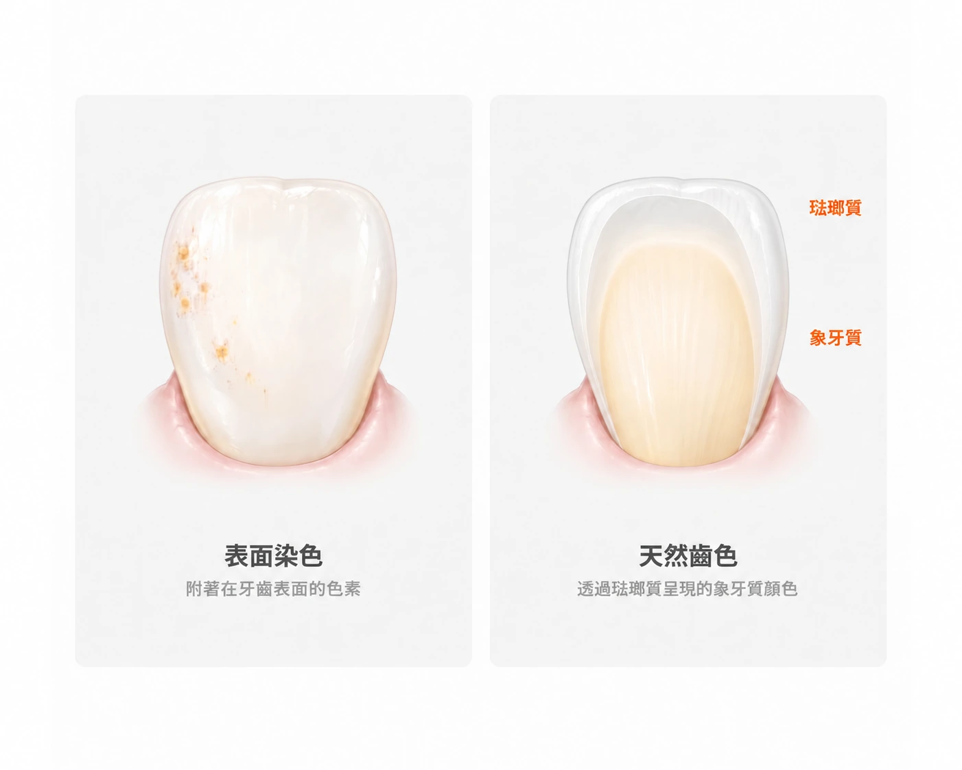 左：附著在牙齒表面的色素。右：象牙質的顏色透過琺瑯質呈現，形成天然牙本來的齒色。