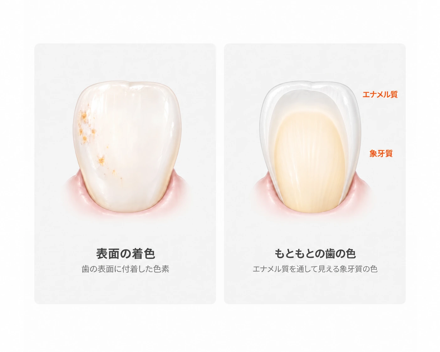 左:歯の表面に付着した色素。右:エナメル質を通して象牙質の色が透けて見える、もともとの歯の色。